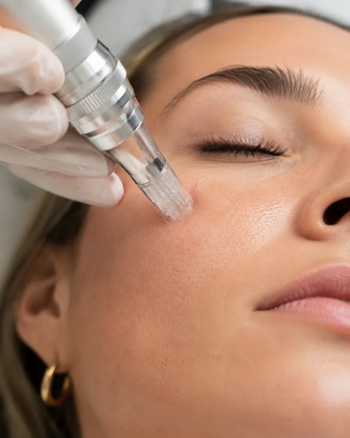 IPCA + Drug Delivery — Klinicá Dermatologia, Barra da Tijuca